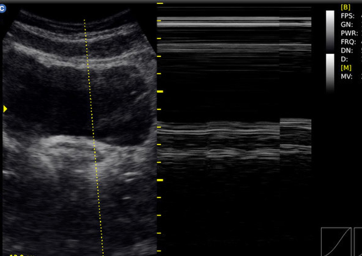 The same muscle imaged in contraction, with measurements